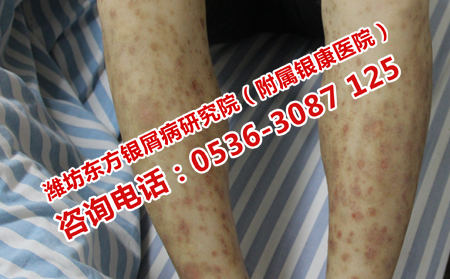 牛皮癬恢復(fù)受阻的原因