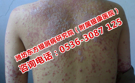 治療牛皮癬理想的醫(yī)院是哪一家呢