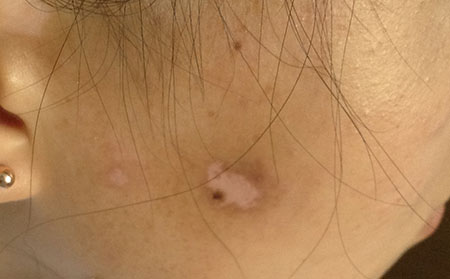 白癜風發(fā)病原因,女性白癜風