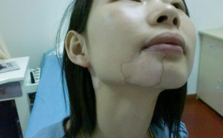 白癜風(fēng)遺傳嗎,白癜風(fēng)會(huì)不會(huì)遺傳給子女