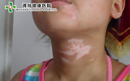 頸部白癜風(fēng)治療,怎樣治頸部白癜風(fēng)